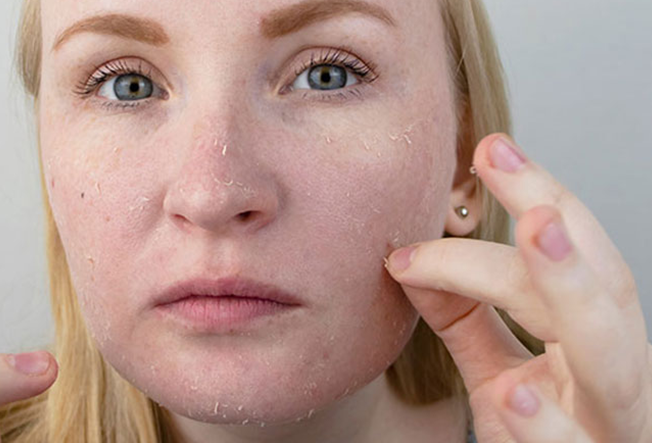 Skin with Dead Cell Buildup