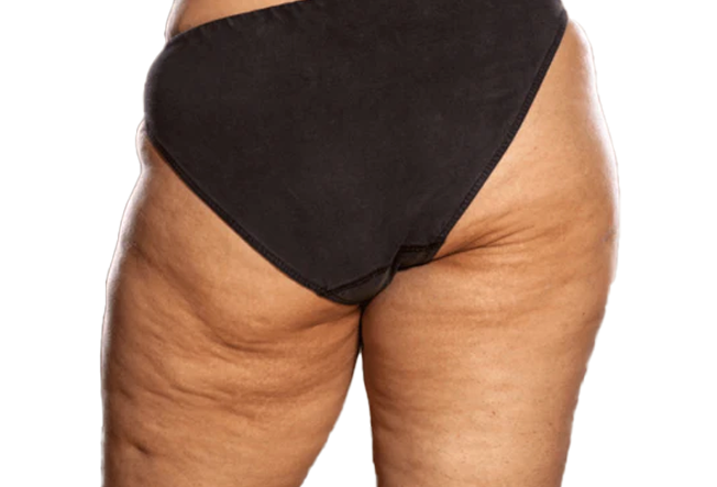 Edematous Cellulite