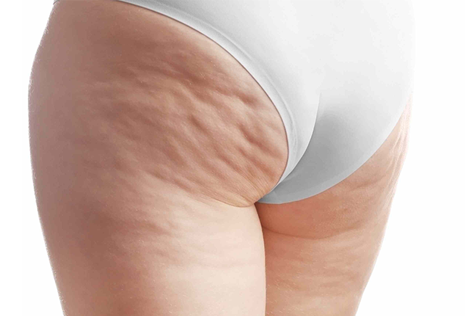 Hard Cellulite