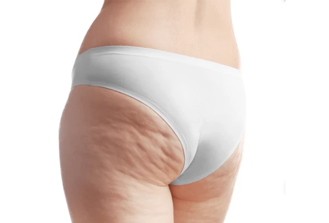 Soft Cellulite