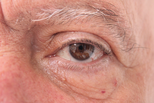 Ectropion and Entropion