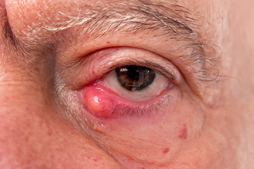 Stye (Hordeolum)
