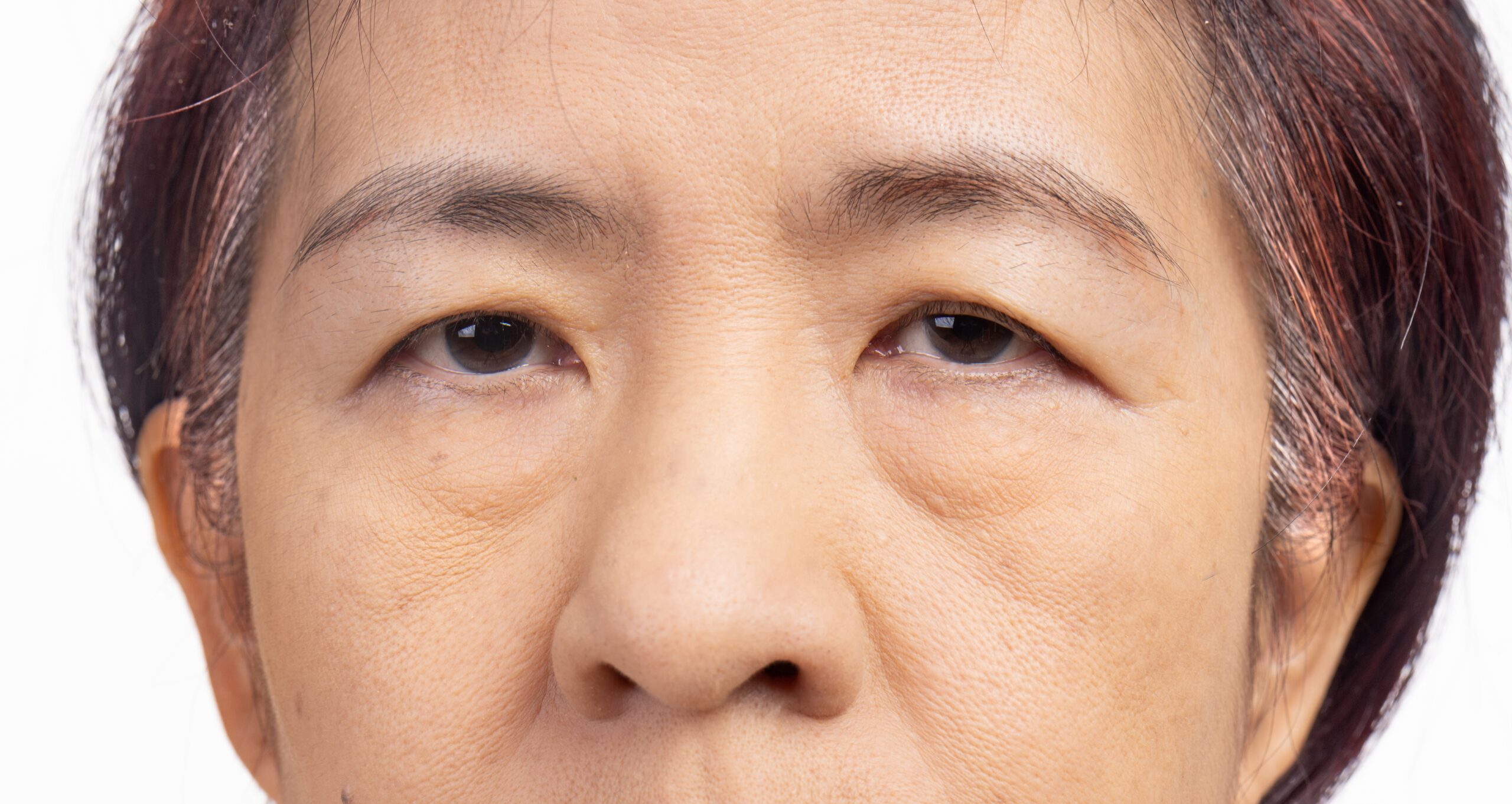 Ptosis (Drooping Eyelid)
