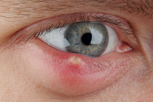 Chalazion