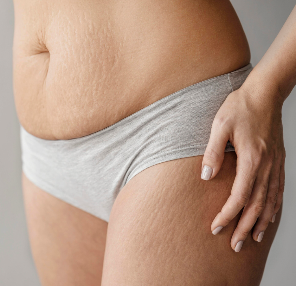 Cellulite Reduction