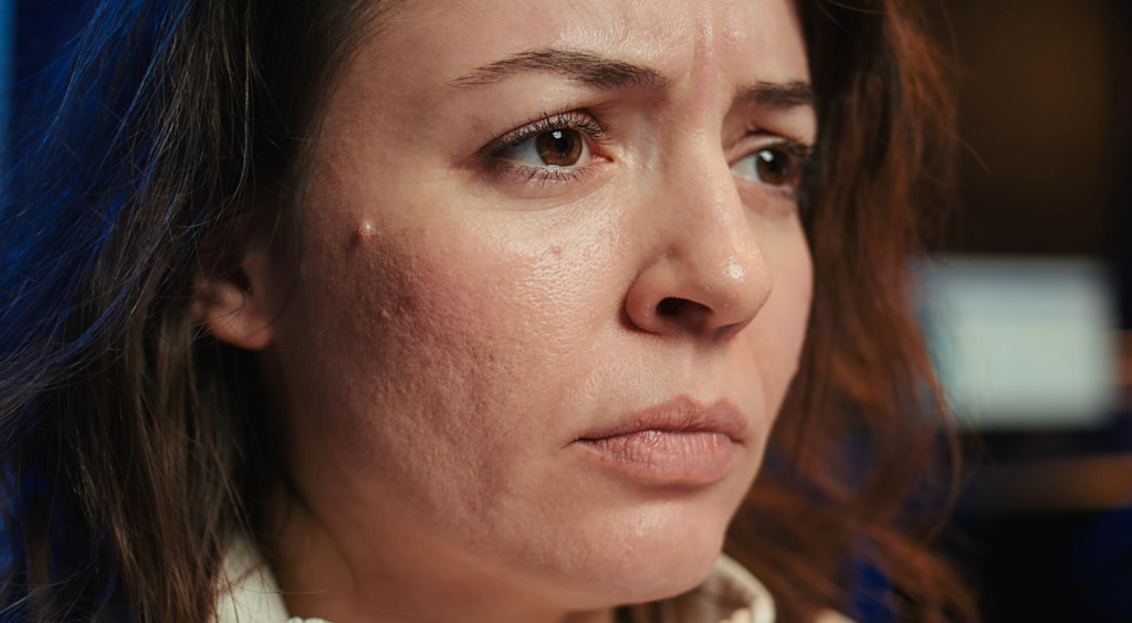 Fractional CO2 laser