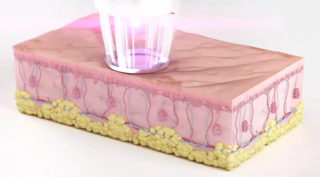 Fractional CO2 laser