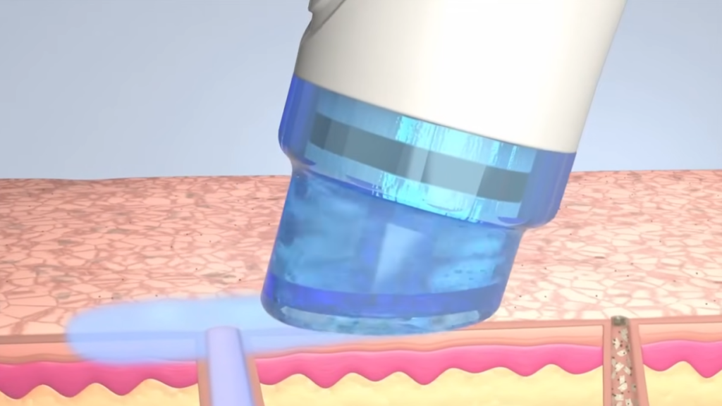 HydraFacial