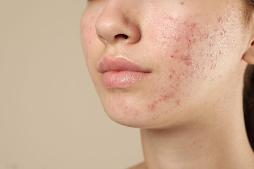 Pico laser treatment being administered for skin pigmentation concerns
